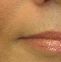 Dermal fillers, lip enhancement - Before