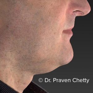 Belkyra treatment by Dr. Praven Chetty at Cerulean Medical Institute in Kelowna, BC - Before photo