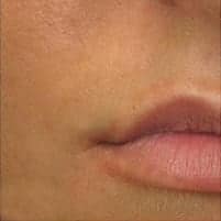 Lip Injections - Before