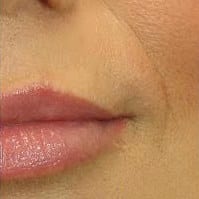 Lip enhancement, dermal fillers - Before