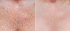 BROWN SPOTS BEFORE AND AFTER