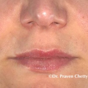 Lip enhancement by Dr. Praven Chetty at Cerulean Medical Institute in Kelowna, BC-after photo
