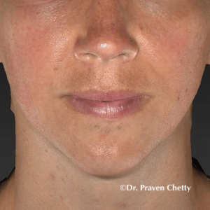 Rosacea Treatment at Cerulean Medical Institute in Kelowna-after photo