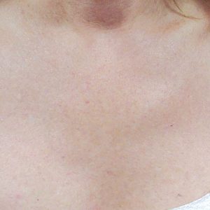 Laser treatment for Brown Spots, Cerulean Medical Institute, Kelowna, BC-after photo