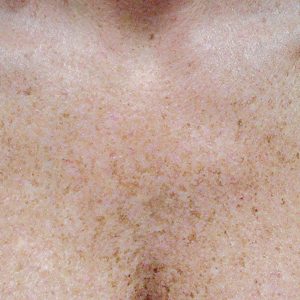 Laser treatment for Brown Spots, Cerulean Medical Institute, Kelowna, BC-before photo