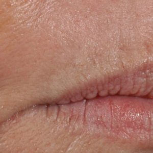 Photo displaying results 'After' dermal filler treatment