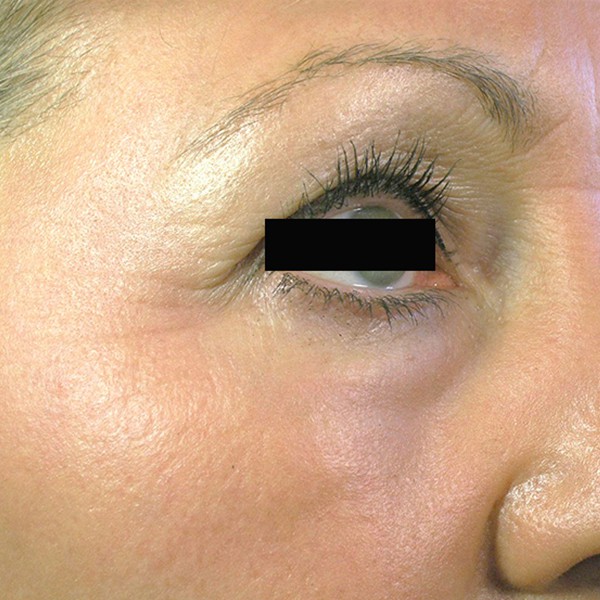 Laser facial treatment Cerulean Medical Institute Kelowna BC