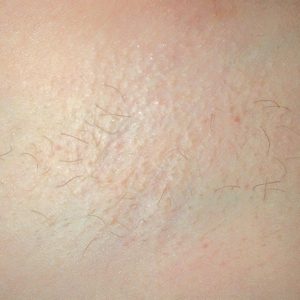 Laser Hair Removal Kelowna-After photo