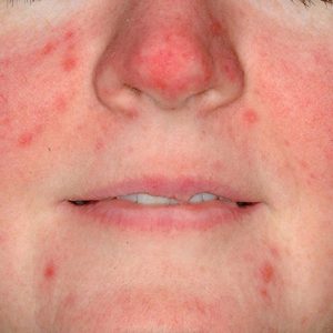 Before Rosacea treatment by Dr. Praven Chetty
