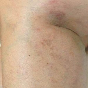 Spider veins treatment at Cerulean Medical Institute in Kelowna, BC-after photo