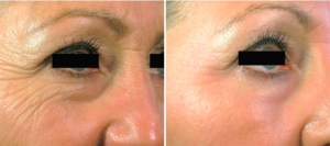 laser facial before and after