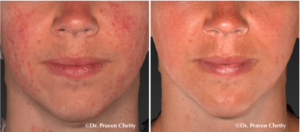 rosacea before and after