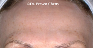 Botox Kelowna Treatment by Dr. Praven Chetty at Cerulean Medical Institute, Kelowna, BC-after BOTOX photo