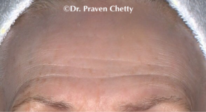 Botox Kelowna Treatment by Dr. Praven Chetty at Cerulean Medical Institute, Kelowna, BC-before BOTOX photo