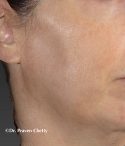 Right cheek after IPL photorejuvenation treatment at Cerulean Medical Institute, Kelowna, BC