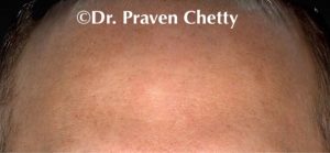 Male after Botox Treatment - Cerulean Medical Institute, Kelowna BC