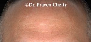 male's forehead before a Botox treatment