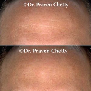 Kelowna Botox - Before and After treatment images