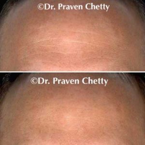 Kelowna Botox Treatment Before & After - Cerulean Medical Institute