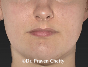 Acne Treatment at Cerulean Medical Institute in Kelowna BC-after photo