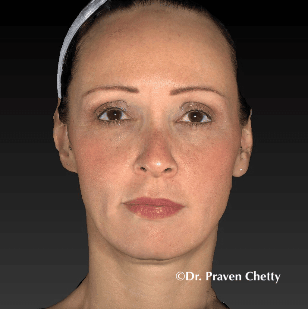 Soft Lift After Photo, Cerulean Medical Institute in Kelowna BC