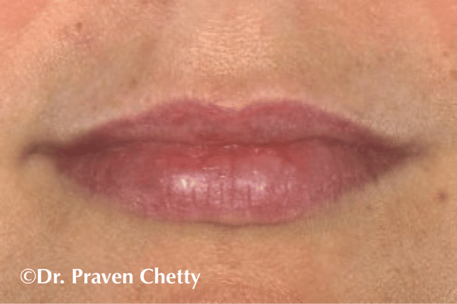 Lip injections by Dr. Praven Chetty at Cerulean Medical Institute in Kelowna, BC-After Photo