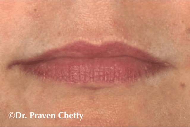 Lip injections by Dr. Praven Chetty at Cerulean Medical Institute in Kelowna, BC-Before Photo