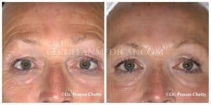 Botox Before and After Photo 4 at Cerulean Medical Institute in Kelowna BC