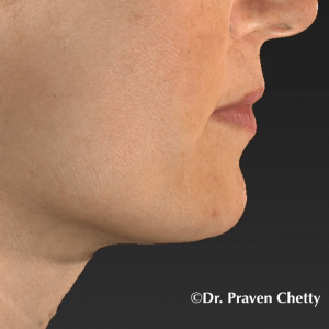 IPL Treatment on right cheek for brown spots on face by Dr. Praven Chetty in Kelowna BC-After Photo