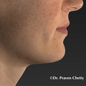 IPL Treatment on right cheek for brown spots on face by Dr. Praven Chetty in Kelowna BC-Before Photo