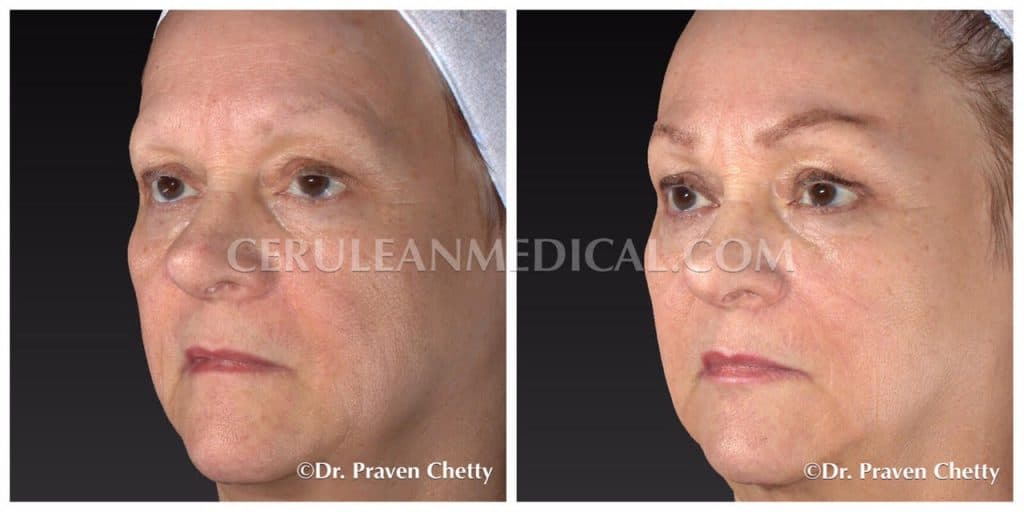 Dermal Fillers Before and After Photo1 at Cerulean Medical Institute in Kelowna BC