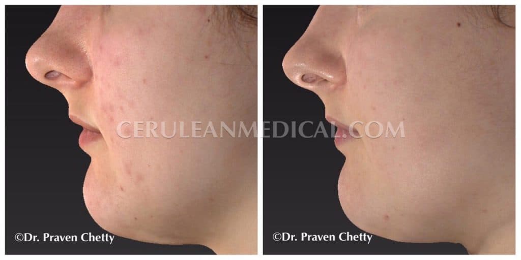 Acne Treatment Before and After Photo 1 at Cerulean Medical Institute in Kelowna BC