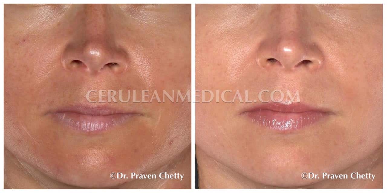 Chemical Peel Before and After Pictures  Russak+ Aesthetic Centre - New  York City, NY