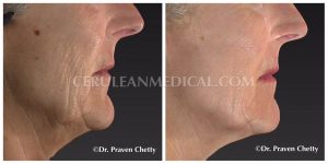 Chemical Peel Before and After Photo 3 at Cerulean Medical Institute in Kelowna BC