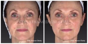 Dermal Fillers Before and After Photo 1 at Cerulean Medical Institute in Kelowna BC