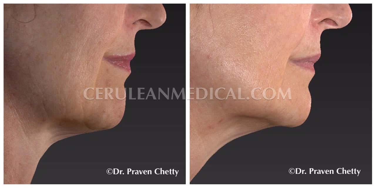 IPL before and After Photo 3 at Cerulean Medical Institute in Kelowna BC