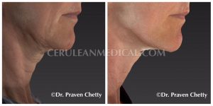 Skin Tightening Treatment Before and After Photo 3 at Cerulean Medical Institute in Kelowna BC