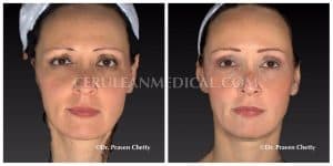 Soft Lift Before and After Photo 1 at Cerulean Medical Institute in Kelowna BC