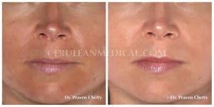 Chemical Peel Before and After Photo 1 at Cerulean Medical Institute in Kelowna BC