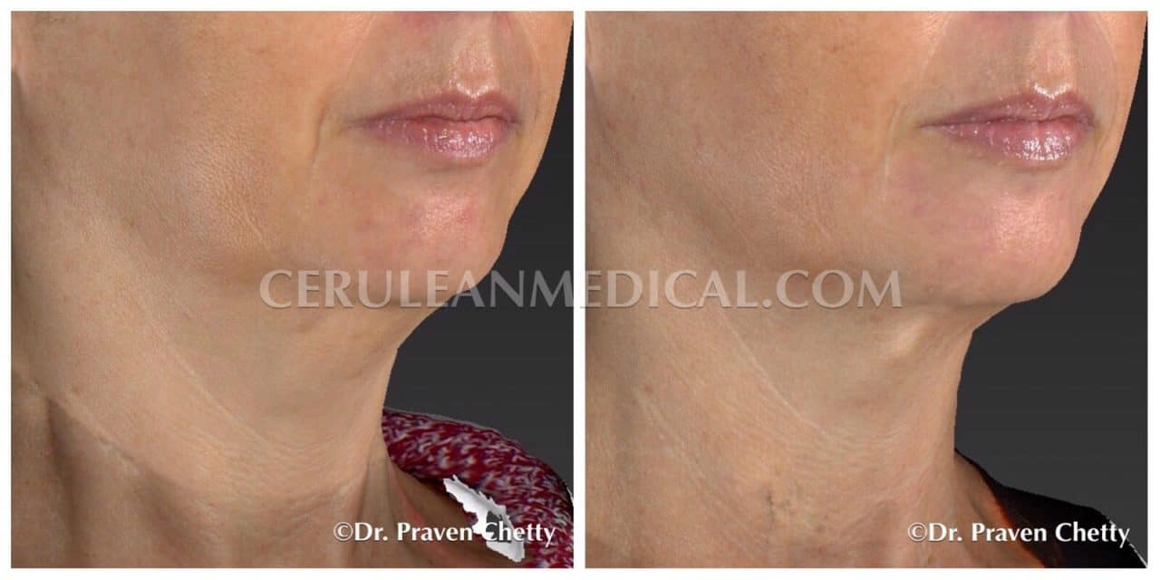 Belkyra Before and After Photo 3 at Cerulean Medical Institute in Kelowna BC