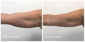 Body Contouring Before and After Photo 1 at Cerulean Medical Institute in Kelowna BC