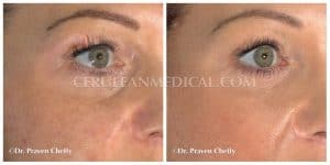 Tear Trough Filler Before and After Photo at Cerulean Medical Institute in Kelowna BC
