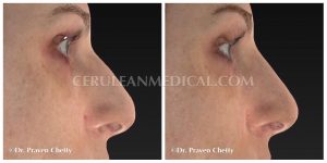 Dermal Fillers Before and After Photo 7 at Cerulean Medical Institute in Kelowna BC