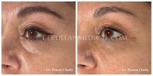 Dermal Fillers Before and After Photo 8 at Cerulean Medical Institute in Kelowna BC