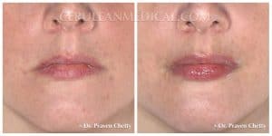 Lip Enhancement Before and After Photo 6 at Cerulean Medical Institute in Kelowna BC