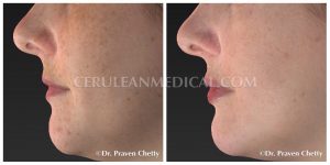 Chemical Peel Before and After Photo 4
