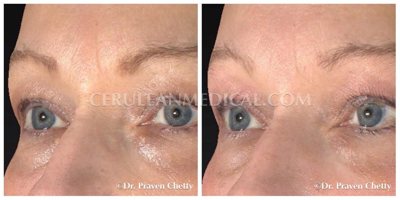 Mole Removal Before and After Photo 4