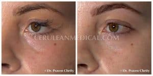 Tear Trough Filler Patient Before and After Photo