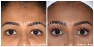 Botox Before and After Photo 1 at Cerulean Medical Institute in Kelowna BC