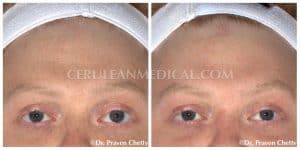 Botox Before and After Photo 10 at Cerulean Medical Institute in Kelowna BC
